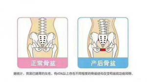 徒手骨盆闭合